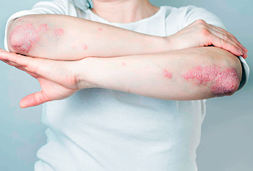 Psoriasis